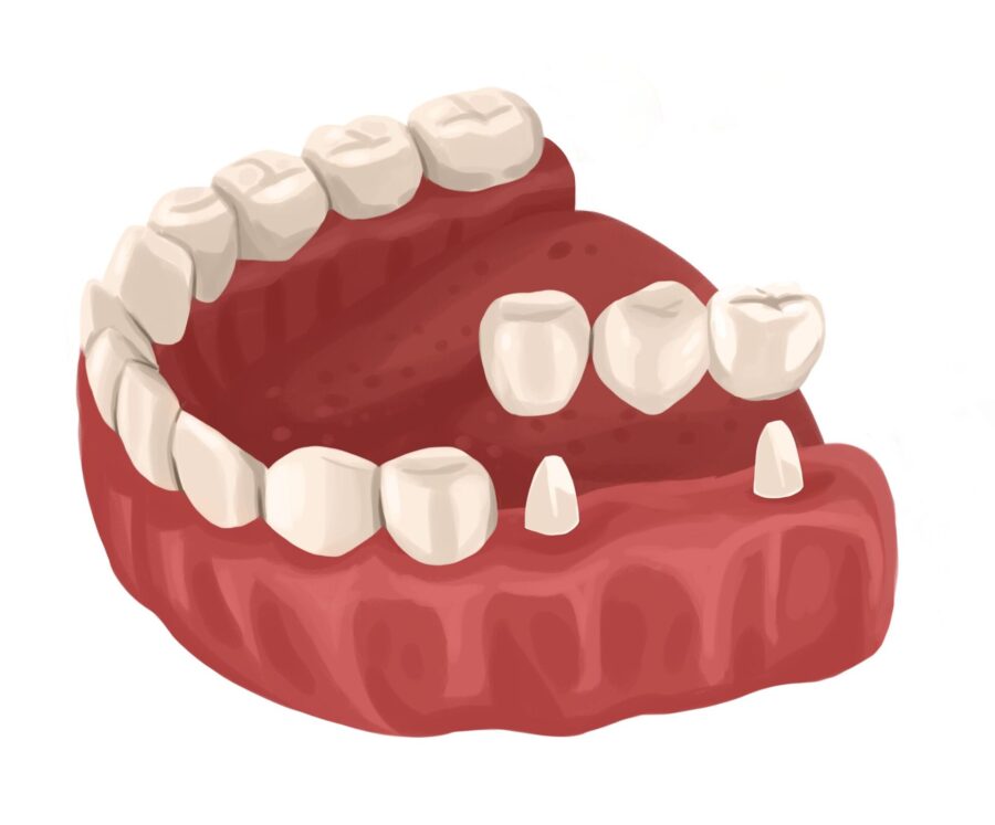 Technical graphic image of a dental bridge. at edgewood family dentistry, a dentist in Anderson, IN