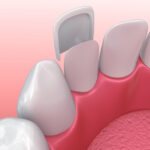 Technical graphic illustration of dental veneer. Veneers vs. crowns.