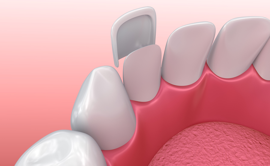 Technical graphic illustration of dental veneer. Veneers vs. crowns. at edgewood family dentistry, a dentist in Anderson, IN