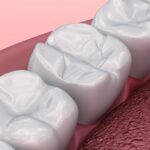 tooth-colored fillings, composite fillings, Edgewood Family Dentistry, Anderson dentist, Dr. Mallory Kuiper, dental restorations, safe dental fillings, natural-looking fillings, oral health, dental care