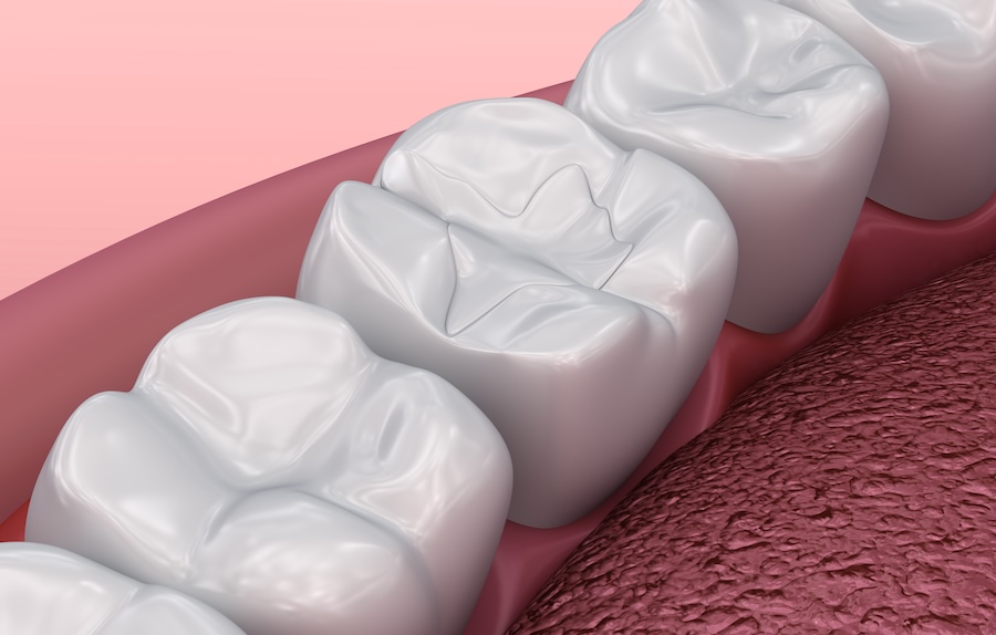 tooth-colored fillings, composite fillings, Edgewood Family Dentistry, Anderson dentist, Dr. Mallory Kuiper, dental restorations, safe dental fillings, natural-looking fillings, oral health, dental care