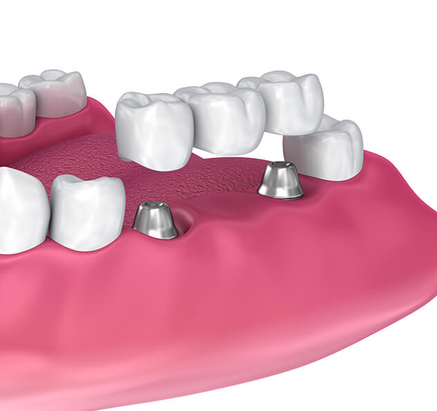 illustration of a dental bridge