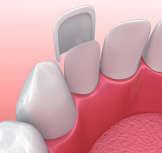 illustration of a dental veneer