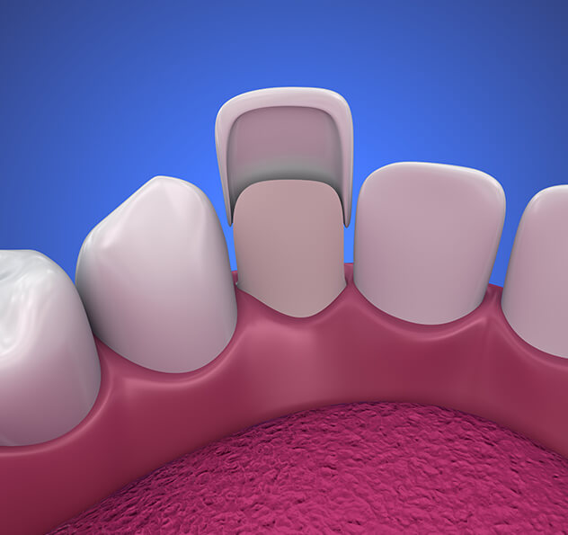 illustration of a dental veneer