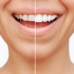 dental veneers before and after, temporary dental veneers