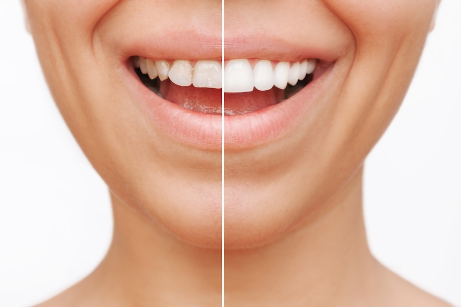 dental veneers before and after, temporary dental veneers