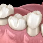 dental crown