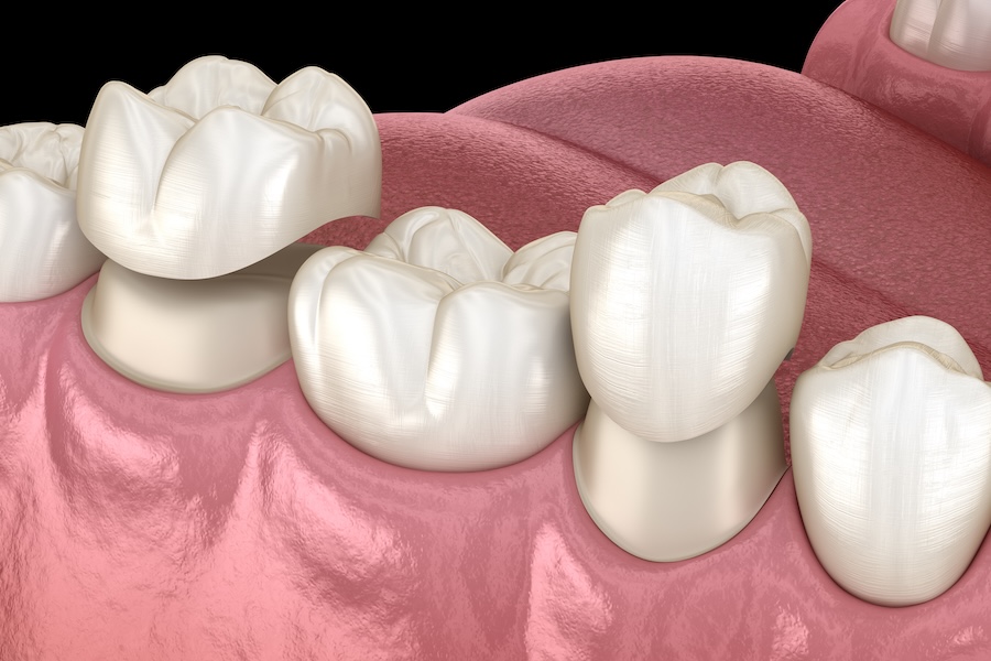 dental crown