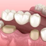traditional dental bridge