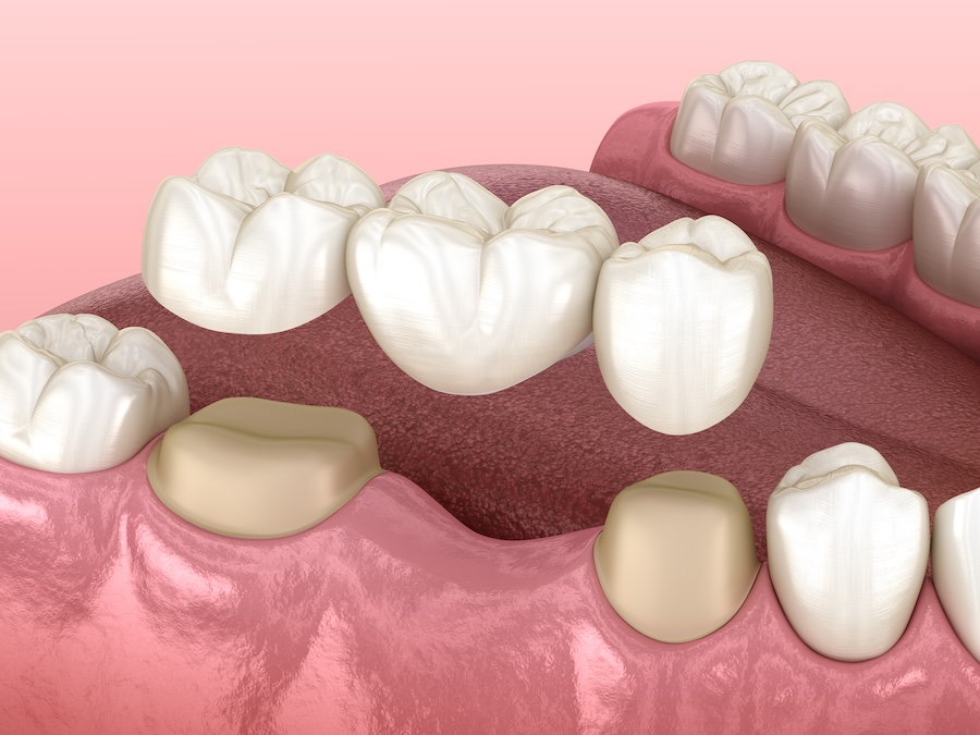 traditional dental bridge