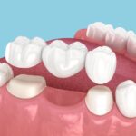 dental bridge for tooth repalcement