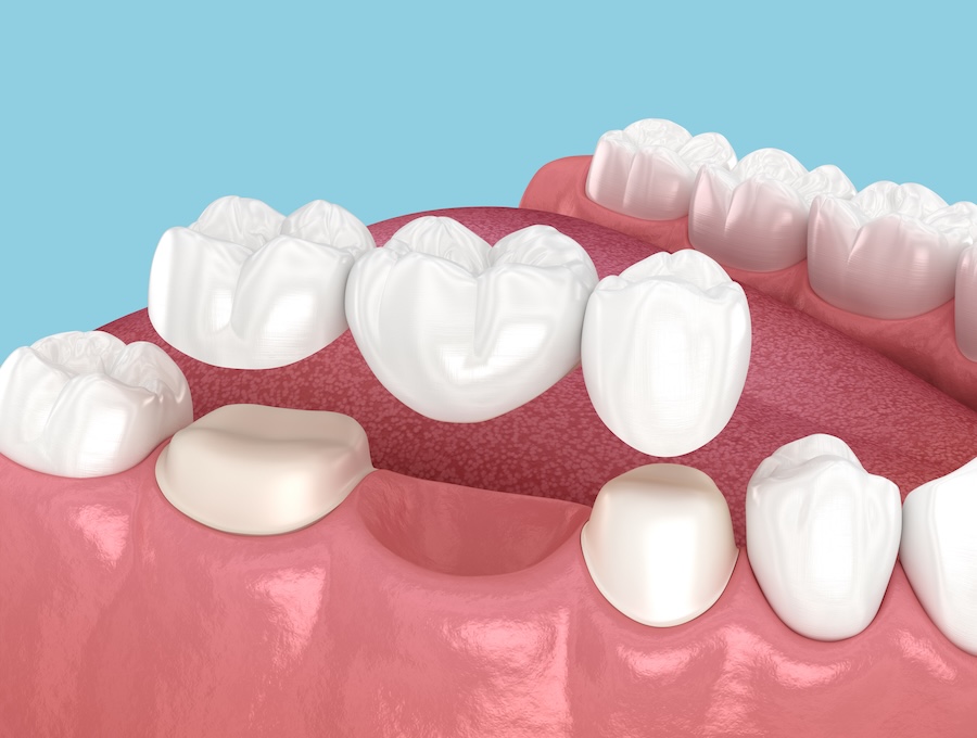 dental bridge for tooth repalcement